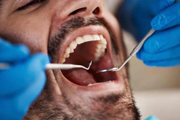 Best Emergency Treatment for Dental Infections or Abscesses in Ardia, CA